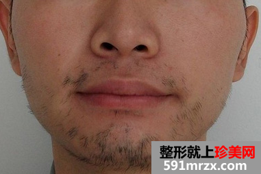 激光脱胡子 轻松甩掉大叔形象