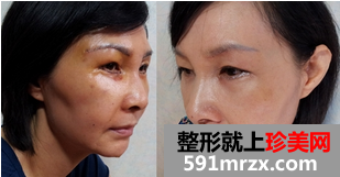 热玛吉,紧致,提升,除皱,恢复,过程,前后,对比,效果,图片