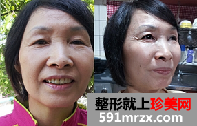 热玛吉,紧致,提升,除皱,恢复,过程,前后,对比,效果,图片