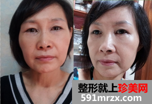 热玛吉,紧致,提升,除皱,恢复,过程,前后,对比,效果,图片