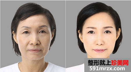 热玛吉,紧致,提升,除皱,恢复,过程,前后,对比,效果,图片