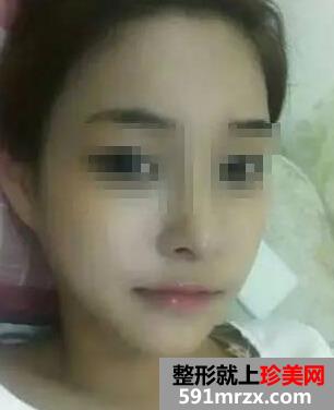 做完假体隆鼻恢复超棒 更加漂亮有自信了