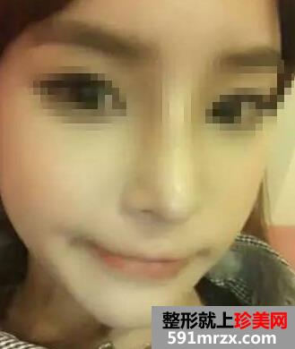 做完假体隆鼻恢复超棒 更加漂亮有自信了