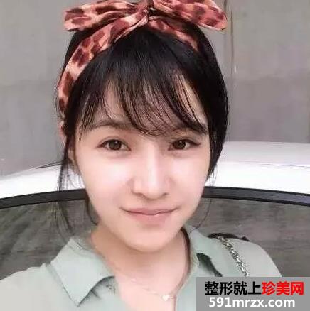 青州市人民医院,膨体假体隆鼻