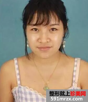 青州市人民医院,膨体假体隆鼻
