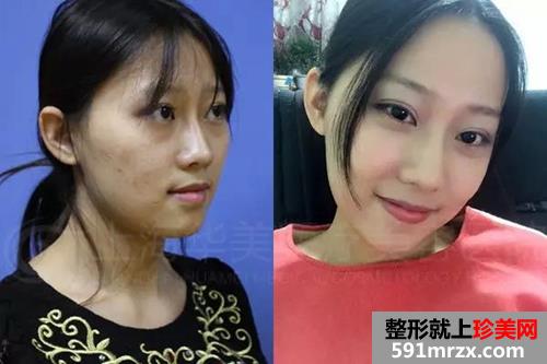 上海,华美,李志海,做的颧骨内推,前后,对比照,年轻了