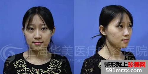 上海,华美,李志海,做的颧骨内推,前后,对比照,年轻了