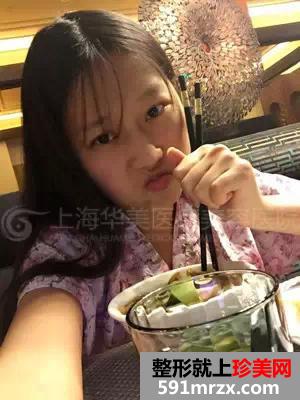上海,华美,李志海,做的颧骨内推,前后,对比照,年轻了