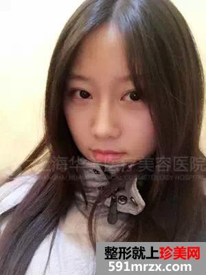 上海,华美,李志海,做的颧骨内推,前后,对比照,年轻了