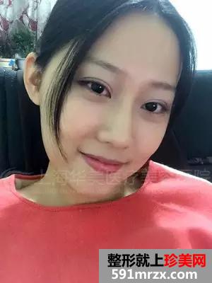 上海,华美,李志海,做的颧骨内推,前后,对比照,年轻了