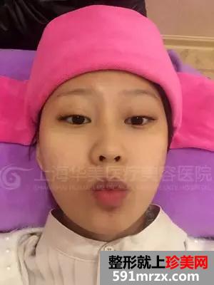上海,华美,李志海,做的颧骨内推,前后,对比照,年轻了
