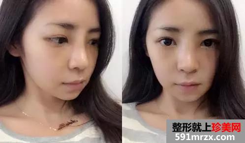 做了注射式隆鼻的她 多了几分“灵气”