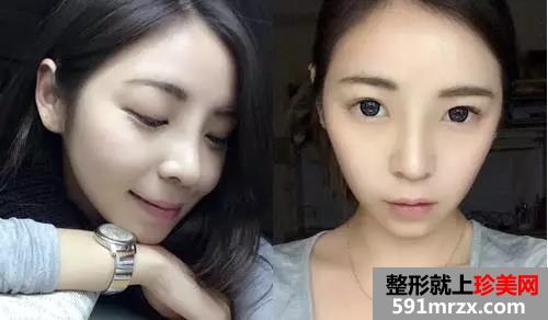 做了注射式隆鼻的她 多了几分“灵气”