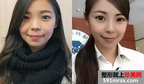 做了注射式隆鼻的她 多了几分“灵气”