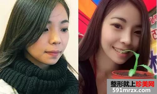 做了注射式隆鼻的她 多了几分“灵气”