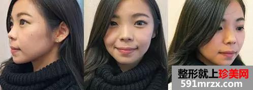 做了注射式隆鼻的她 多了几分“灵气”