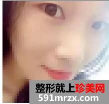宁波,美莱,双眼皮,45天了,有图有真相哦