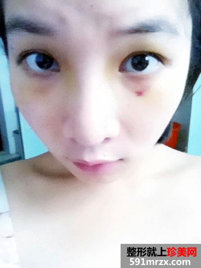 鼻子整形手术后 人活着就靠这一张脸