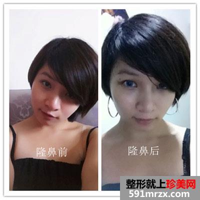 鼻子整形手术后 人活着就靠这一张脸