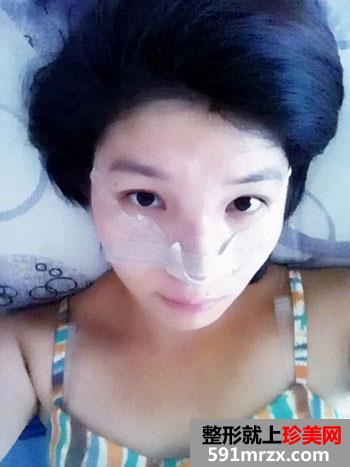 鼻子整形手术后 人活着就靠这一张脸