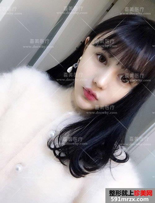 鼻部修复+脂肪全脸填充术后2个多月|附上前后对比图