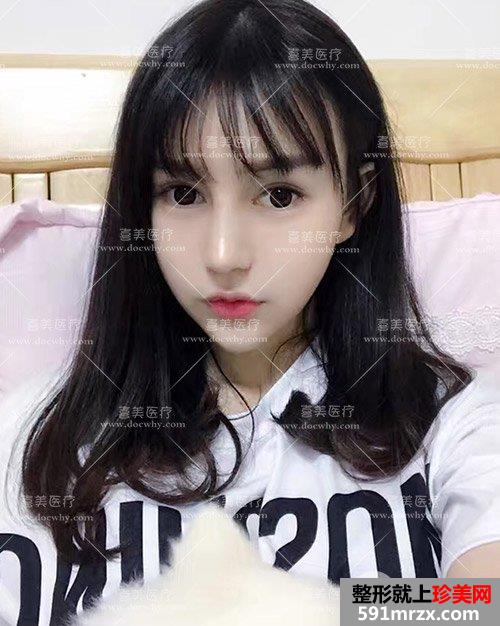 鼻部修复+脂肪全脸填充术后2个多月|附上前后对比图