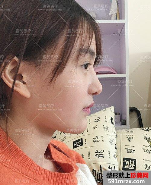 鼻部修复+脂肪全脸填充术后2个多月|附上前后对比图