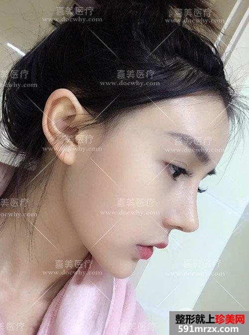 鼻部修复+脂肪全脸填充术后2个多月|附上前后对比图