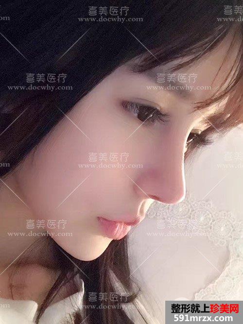 鼻部修复+脂肪全脸填充术后2个多月|附上前后对比图