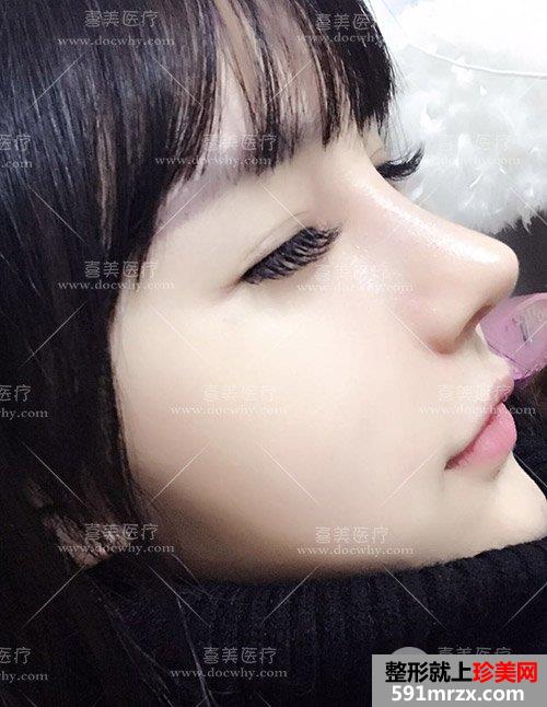 鼻部修复+脂肪全脸填充术后2个多月|附上前后对比图