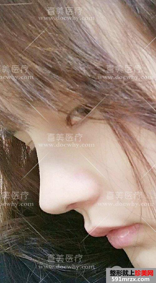 鼻部修复+脂肪全脸填充术后2个多月|附上前后对比图