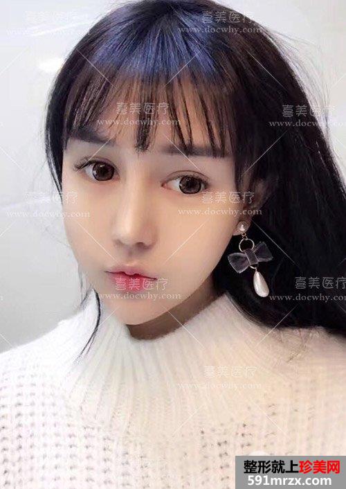 鼻部修复+脂肪全脸填充术后2个多月|附上前后对比图