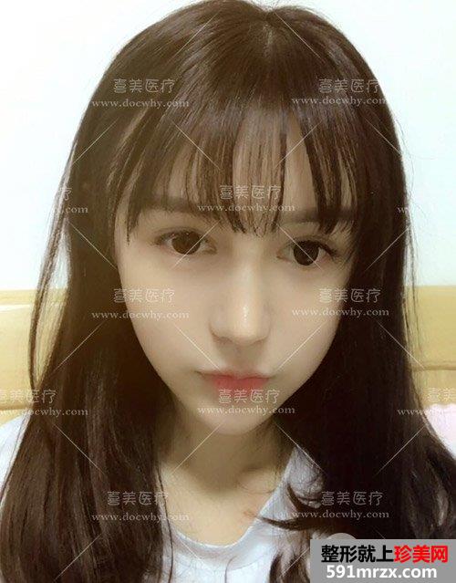 鼻部修复+脂肪全脸填充术后2个多月|附上前后对比图