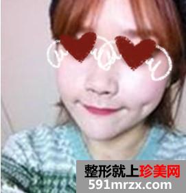 人造酒窝