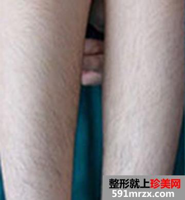在北京医院做的蓝宝石冰点脱毛手术