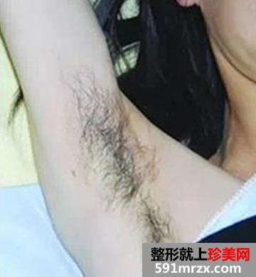 在北京医院做的蓝宝石冰点脱毛手术