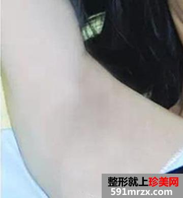 在北京医院做的蓝宝石冰点脱毛手术