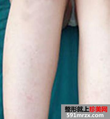 在北京医院做的蓝宝石冰点脱毛手术