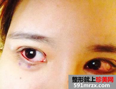 切开法双眼皮修复术前后效果对比图和整形后记