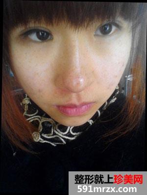 做了激光祛咖啡斑 终于不用再羡慕别人了