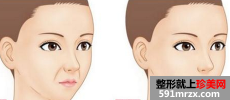 自体脂肪填充鼻唇沟原理 自体脂肪填充鼻唇沟前后对比图