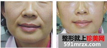 自体脂肪填充鼻唇沟原理 自体脂肪填充鼻唇沟前后对比图