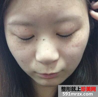 激光美容祛斑好不好