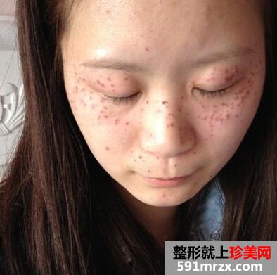 激光美容祛斑好不好