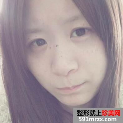 激光美容祛斑好不好