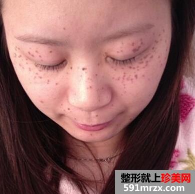激光美容祛斑好不好