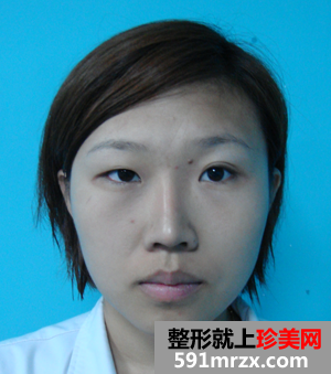 北京,八大处,靳小雷,做的双眼皮,丰面颊,还不错
