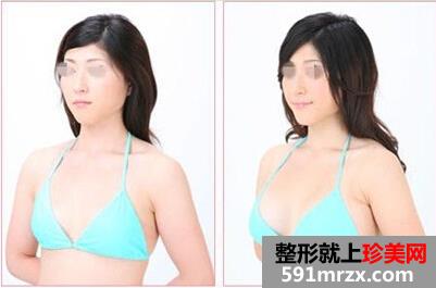 大龄剩女患癌失乳 千里赴深重造“事业线”