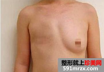 大龄剩女患癌失乳 千里赴深重造“事业线”