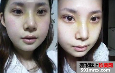 【真人案例】颧骨+下巴+眼睛+鼻子一次搞定